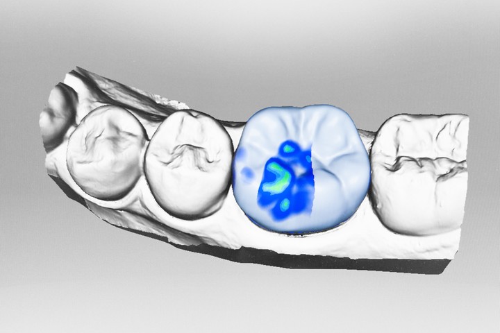 Cerec-kronen in één behandeling