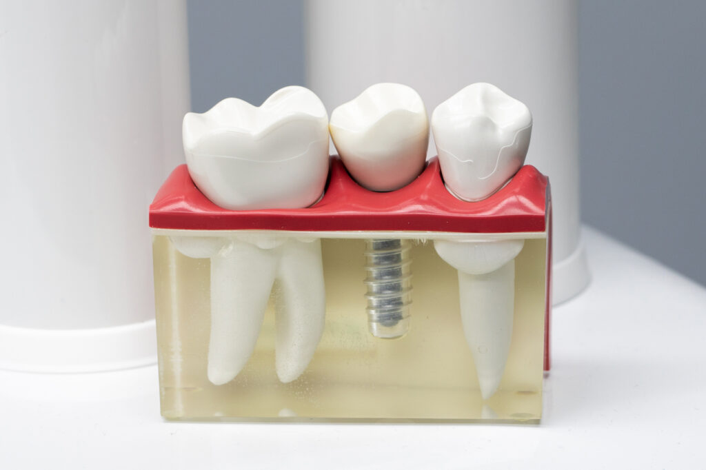 Implantaten